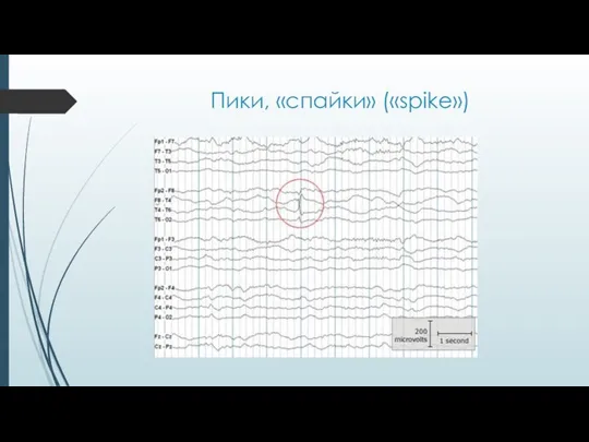 Пики, «спайки» («spike»)