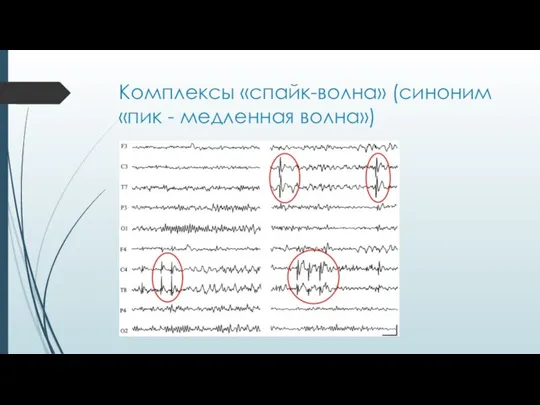 Комплексы «спайк-волна» (синоним «пик - медленная волна»)