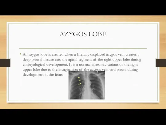 AZYGOS LOBE An azygos lobe is created when a laterally displaced