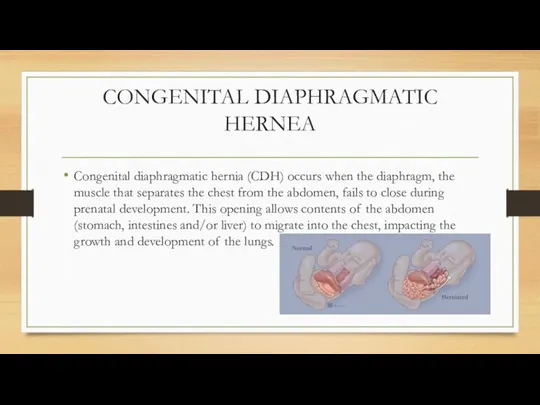 CONGENITAL DIAPHRAGMATIC HERNEA Congenital diaphragmatic hernia (CDH) occurs when the diaphragm,