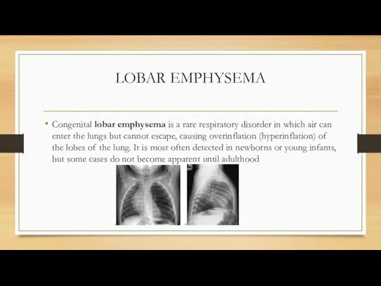 LOBAR EMPHYSEMA Congenital lobar emphysema is a rare respiratory disorder in