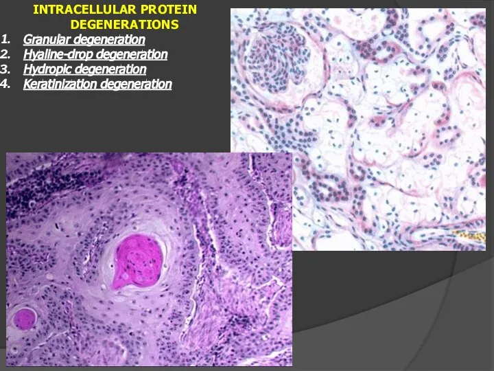 INTRACELLULAR PROTEIN DEGENERATIONS Granular degeneration Hyaline-drop degeneration Hydropic degeneration Keratinization degeneration