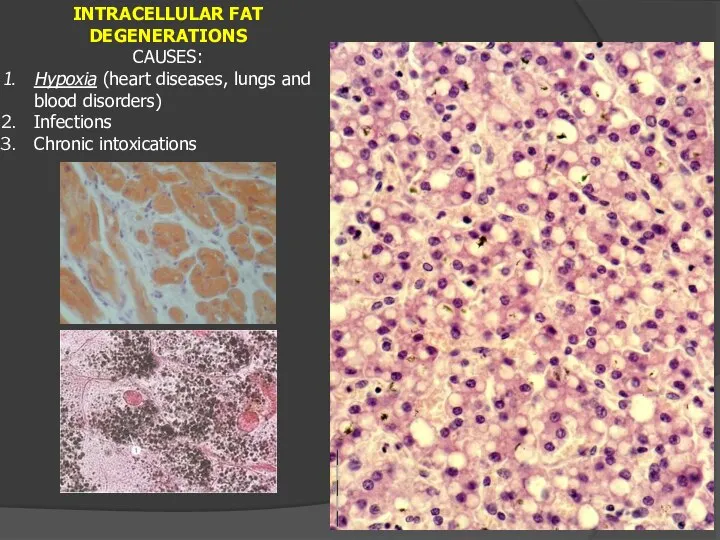 INTRACELLULAR FAT DEGENERATIONS CAUSES: Hypoxia (heart diseases, lungs and blood disorders) Infections Chronic intoxications