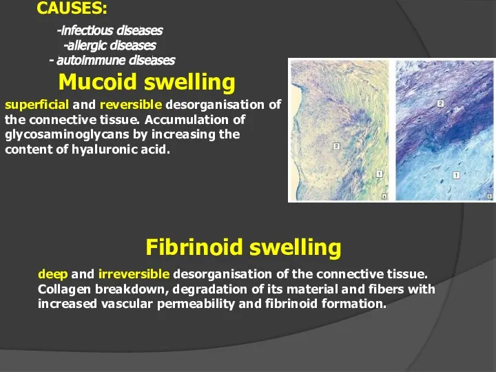 Mucoid swelling superficial and reversible desorganisation of the connective tissue. Accumulation