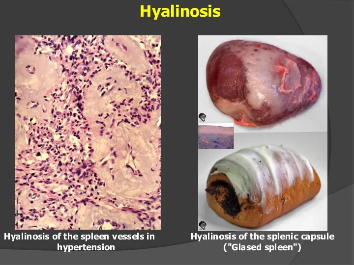 Hyalinosis Hyalinosis of the spleen vessels in hypertension Hyalinosis of the splenic capsule ("Glased spleen")