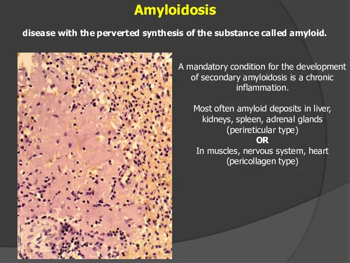 Amyloidosis disease with the perverted synthesis of the substance called amyloid.