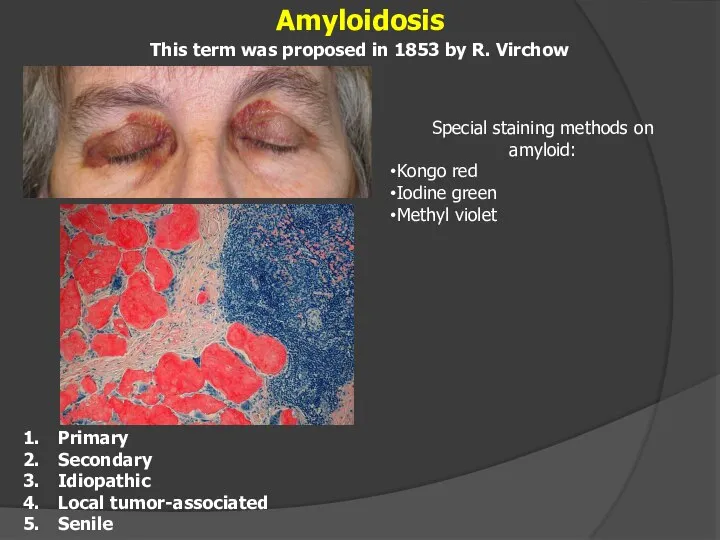 Amyloidosis Primary Secondary Idiopathic Local tumor-associated Senile This term was proposed