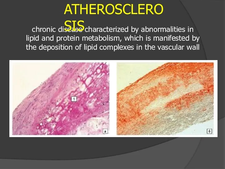 chronic disease characterized by abnormalities in lipid and protein metabolism, which