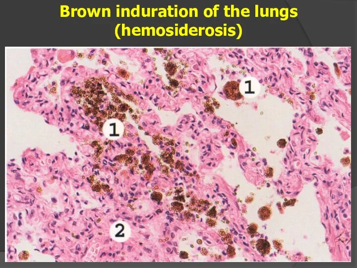 Brown induration of the lungs (hemosiderosis)