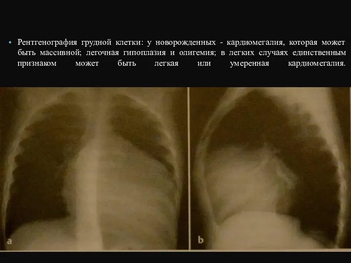 Рентгенография грудной клетки: у новорожденных - кардиомегалия, которая может быть массивной;