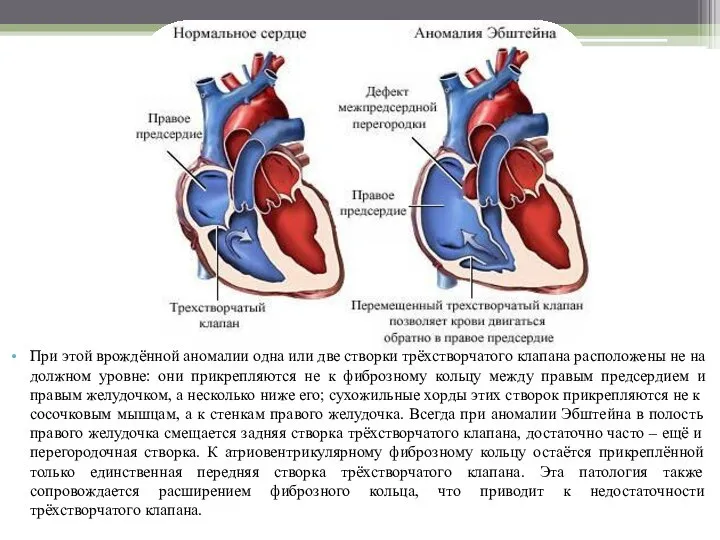 При этой врождённой аномалии одна или две створки трёхстворчатого клапана расположены