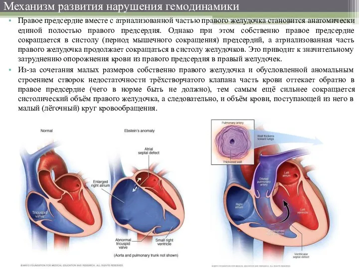 Механизм развития нарушения гемодинамики Правое предсердие вместе с атриализованной частью правого