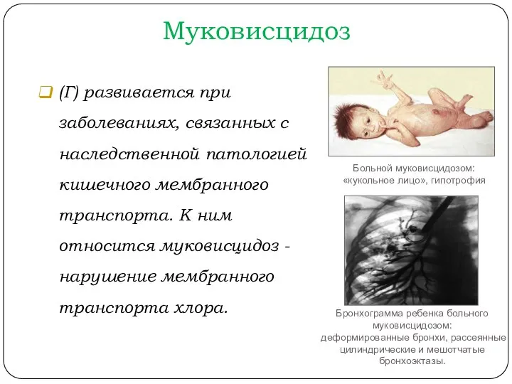 Муковисцидоз (Г) развивается при заболеваниях, связанных с наследственной патологией кишечного мембранного