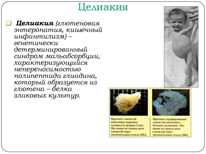 Целиакия Целиакия (глютеновая энтеропатия, кишечный инфантилизм) – генетически детерминированный синдром мальабсорбции,