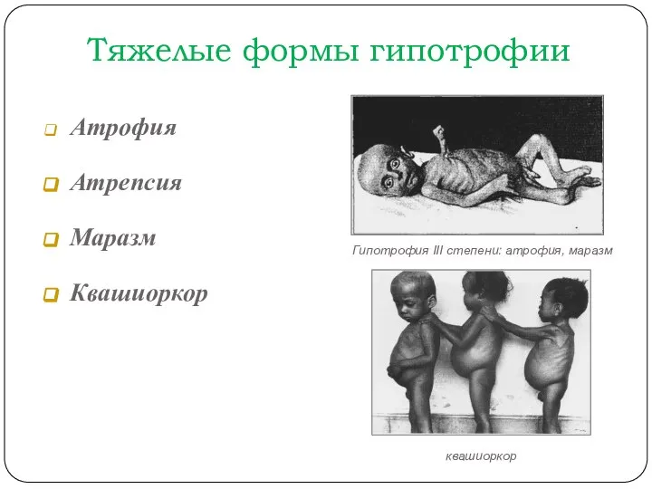 Тяжелые формы гипотрофии Атрофия Атрепсия Маразм Квашиоркор Гипотрофия III степени: атрофия, маразм квашиоркор