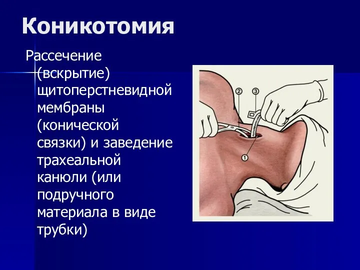 Коникотомия Рассечение (вскрытие) щитоперстневидной мембраны (конической связки) и заведение трахеальной канюли