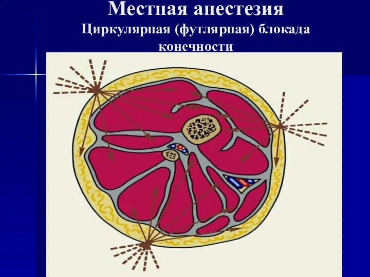 Местная анестезия Циркулярная (футлярная) блокада конечности