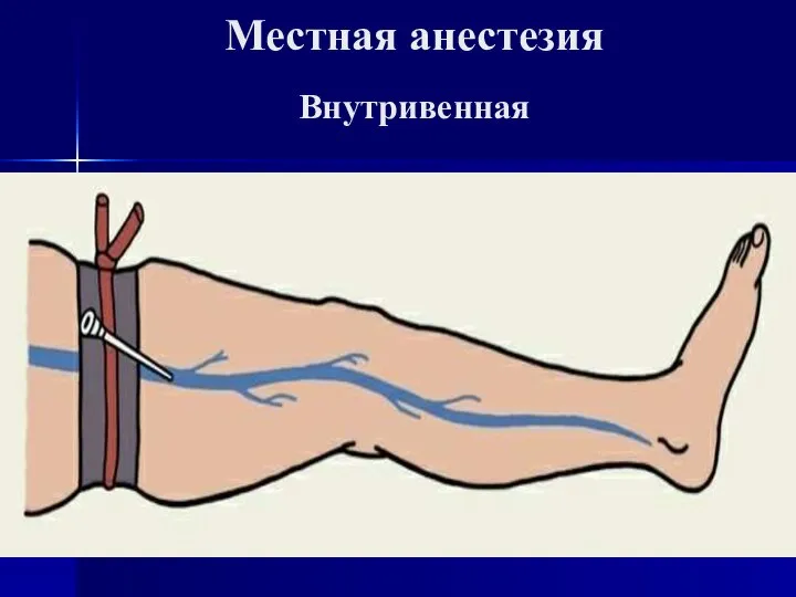 Местная анестезия Внутривенная