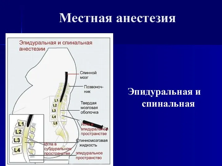 Местная анестезия Эпидуральная и спинальная