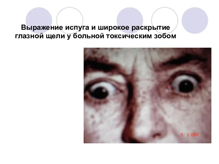 Выражение испуга и широкое раскрытие глазной щели у больной токсическим зобом