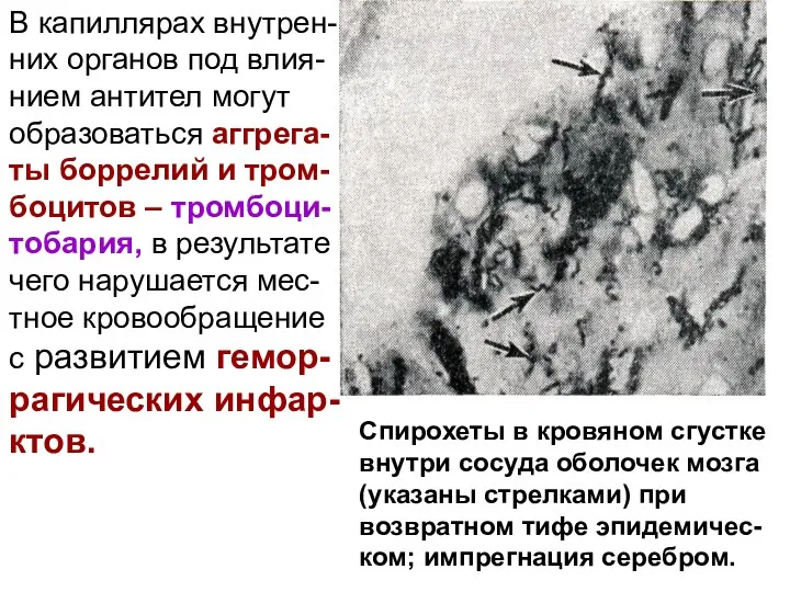 В капиллярах внутрен-них органов под влия-нием антител могут образоваться аггрега-ты боррелий