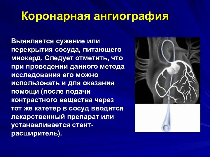 Выявляется сужение или перекрытия сосуда, питающего миокард. Следует отметить, что при