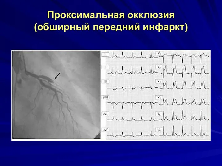 Проксимальная окклюзия (обширный передний инфаркт)