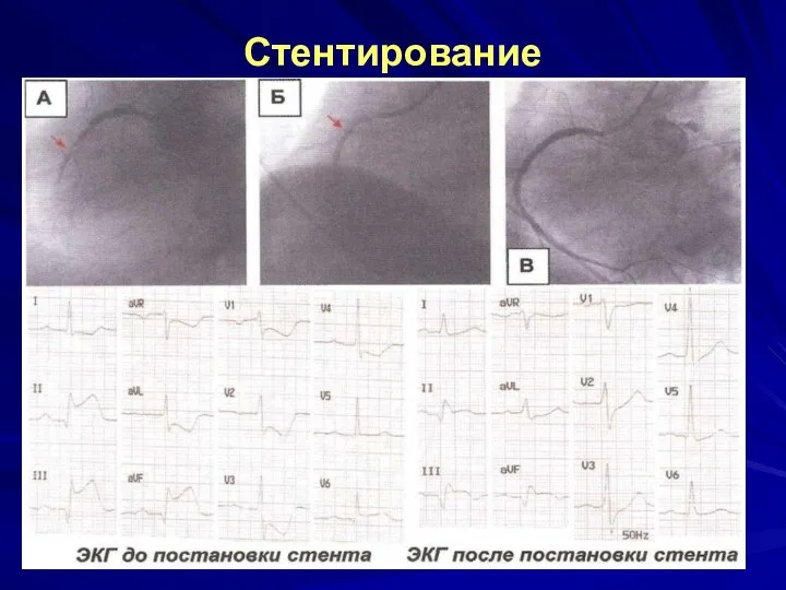 Стентирование