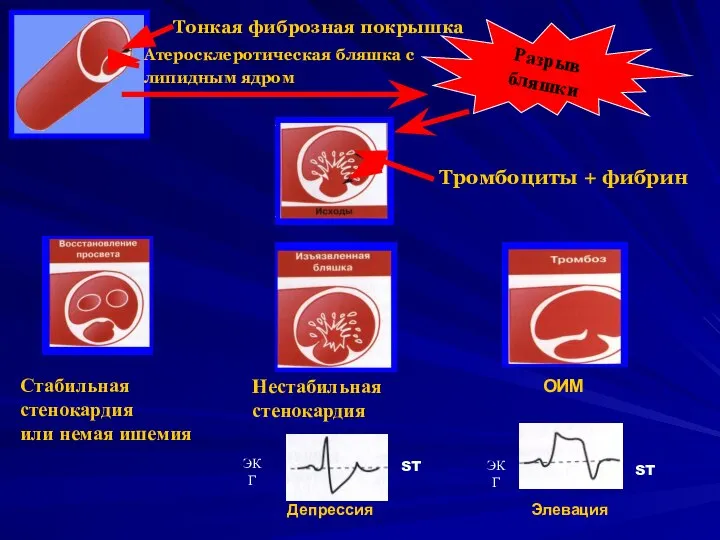Разрыв бляшки Стабильная стенокардия или немая ишемия Нестабильная стенокардия ЭКГ ST
