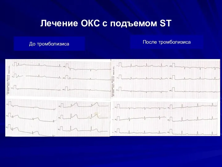 Лечение ОКС с подъемом ST До тромболизиса После тромболизиса