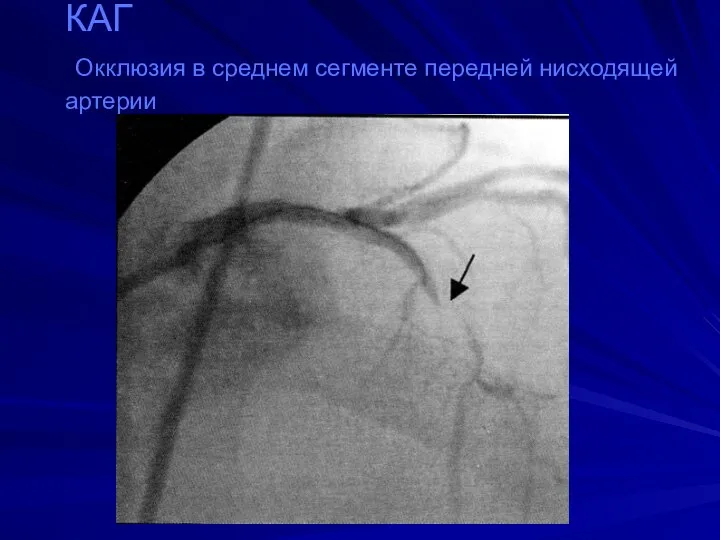 КАГ Окклюзия в среднем сегменте передней нисходящей артерии