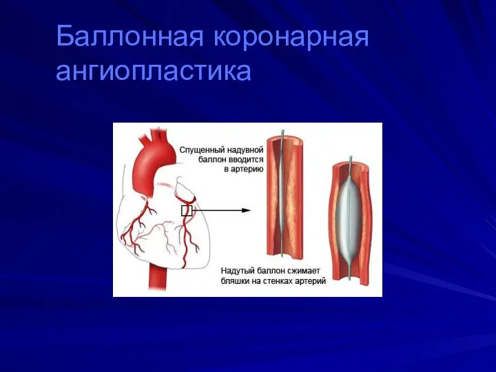 Баллонная коронарная ангиопластика