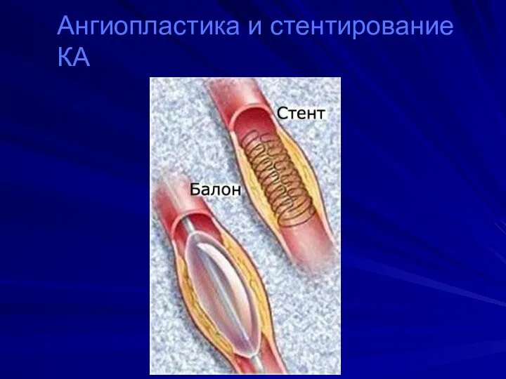 Ангиопластика и стентирование КА