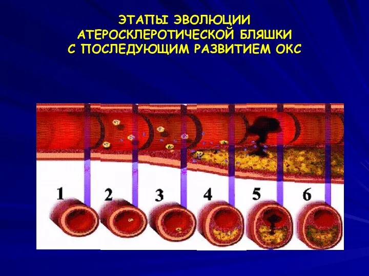 ЭТАПЫ ЭВОЛЮЦИИ АТЕРОСКЛЕРОТИЧЕСКОЙ БЛЯШКИ С ПОСЛЕДУЮЩИМ РАЗВИТИЕМ ОКС