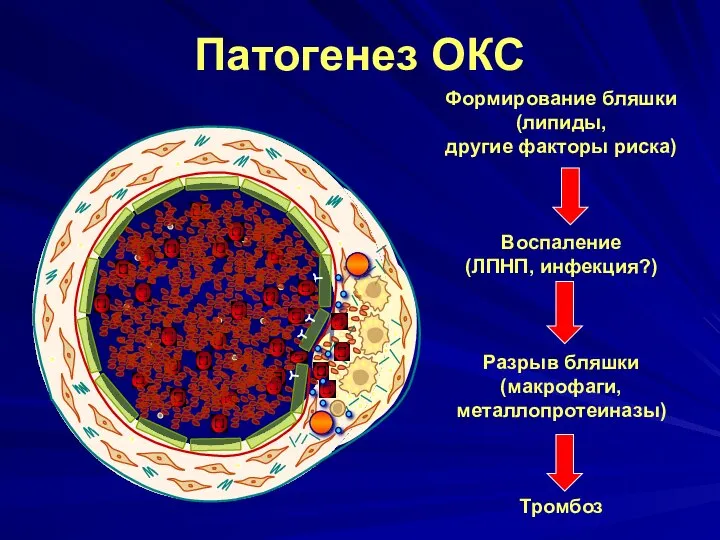 Патогенез ОКС Формирование бляшки (липиды, другие факторы риска) Воспаление (ЛПНП, инфекция?) Разрыв бляшки (макрофаги, металлопротеиназы) Тромбоз