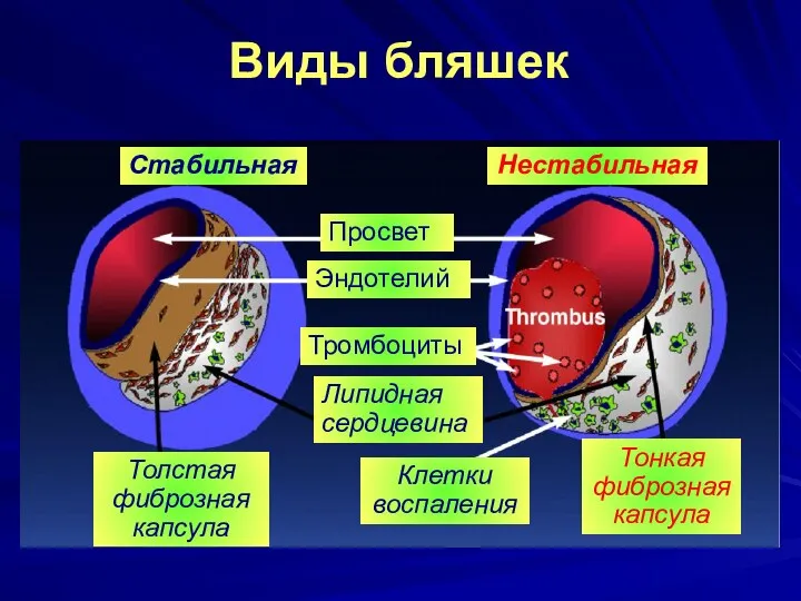 Виды бляшек Falk E, et al. Circulation. 1995;92:657-671 Стабильная Нестабильная Толстая