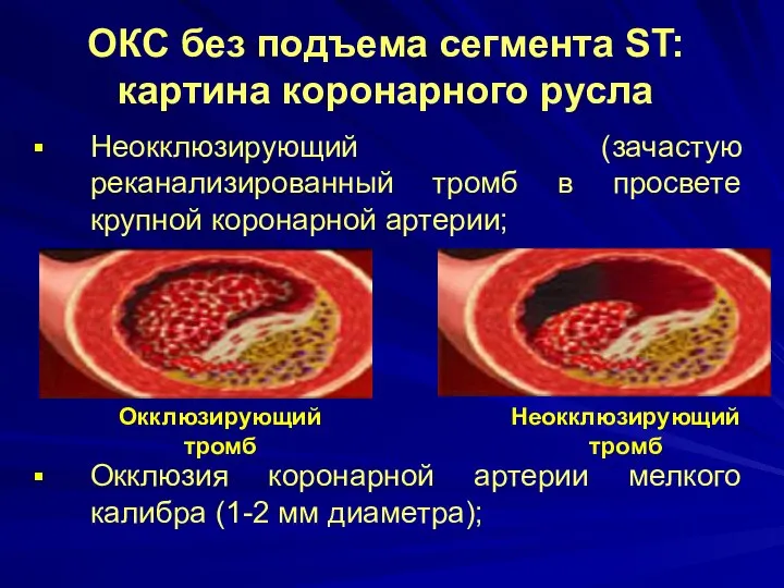 ОКС без подъема сегмента ST: картина коронарного русла Неокклюзирующий (зачастую реканализированный