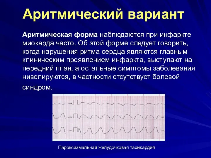 Аритмический вариант Аритмическая форма наблюдаются при инфаркте миокарда часто. Об этой