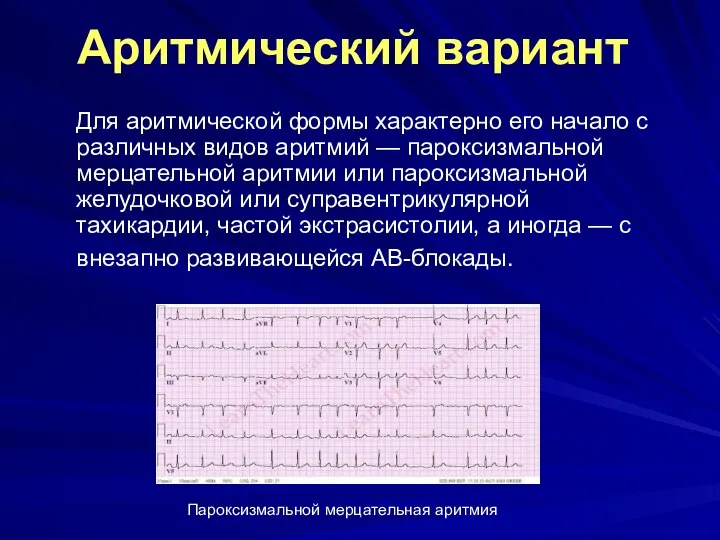 Аритмический вариант Для аритмической формы характерно его начало с различных видов