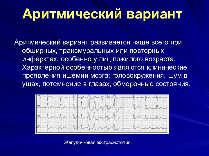 Аритмический вариант Аритмический вариант развивается чаще всего при обширных, трансмуральных или