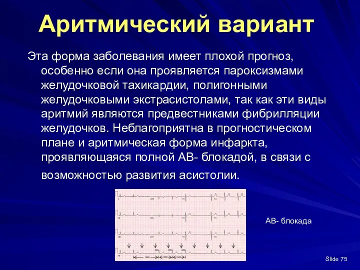 Slide Аритмический вариант Эта форма заболевания имеет плохой прогноз, особенно если