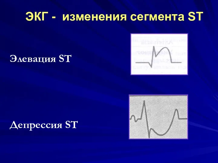 Элевация ST Депрессия ST ЭКГ - изменения сегмента ST