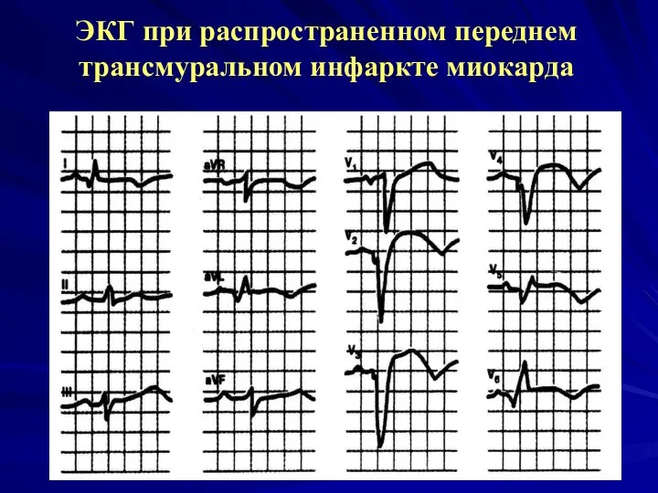 ЭКГ при распространенном переднем трансмуральном инфаркте миокарда