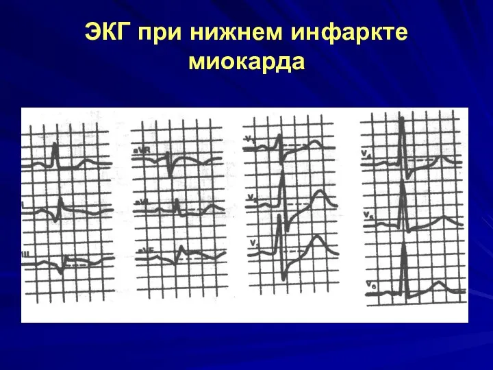 ЭКГ при нижнем инфаркте миокарда