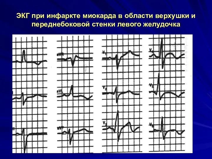 ЭКГ при инфаркте миокарда в области верхушки и переднебоковой стенки левого желудочка