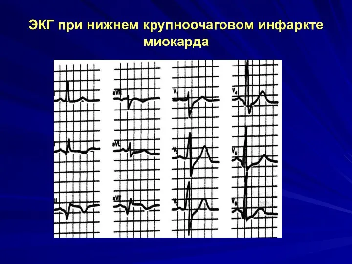 ЭКГ при нижнем крупноочаговом инфаркте миокарда