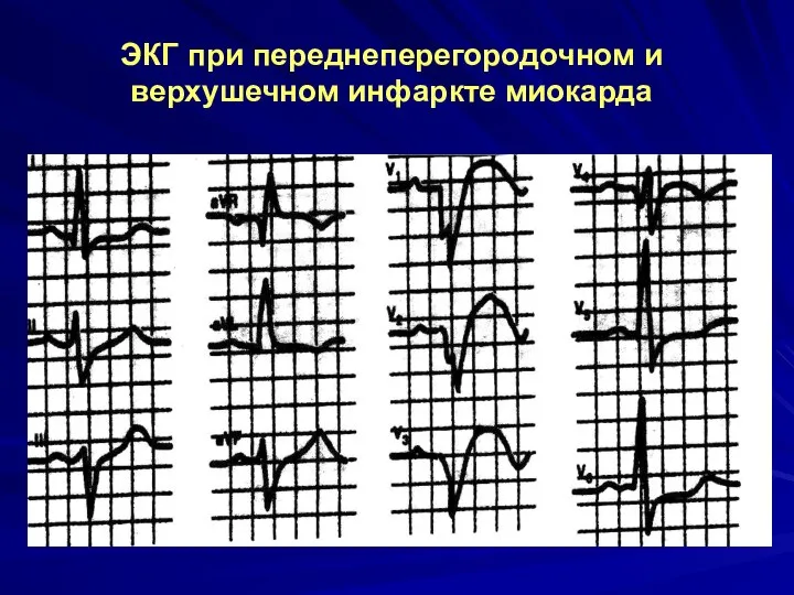 ЭКГ при переднеперегородочном и верхушечном инфаркте миокарда