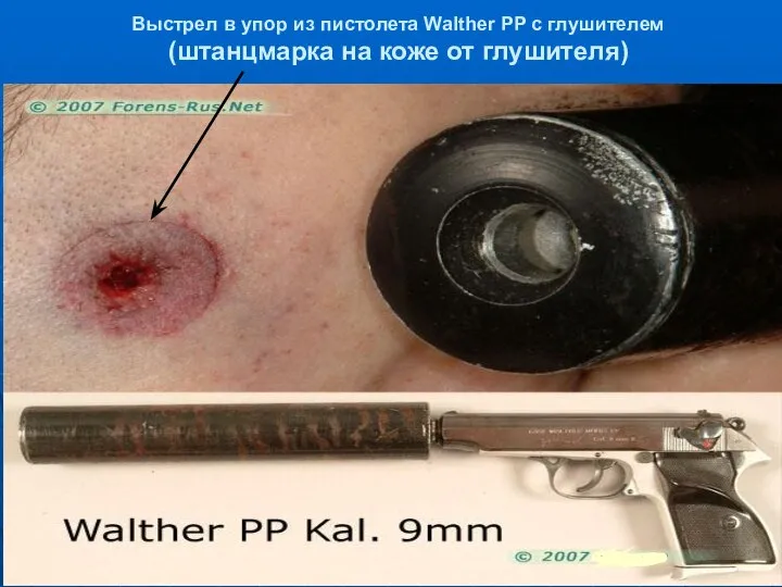 Выстрел в упор из пистолета Walther PP с глушителем (штанцмарка на коже от глушителя)