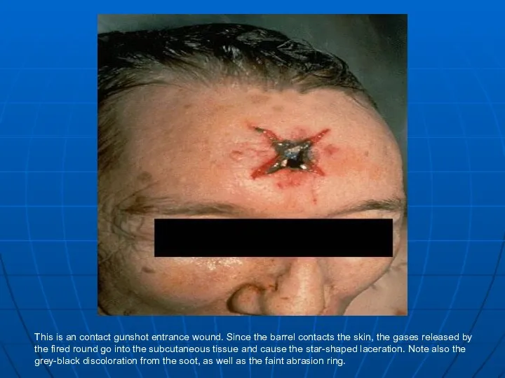 This is an contact gunshot entrance wound. Since the barrel contacts