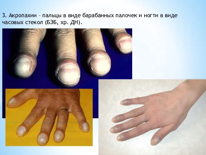 3. Акропахии – пальцы в виде барабанных палочек и ногти в
